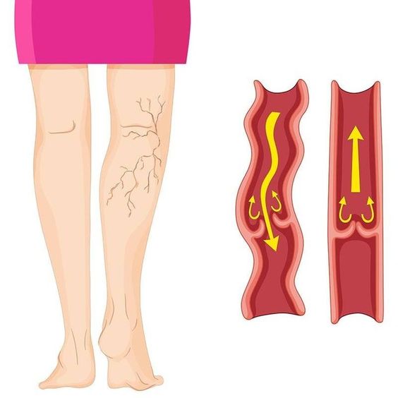 How to Remove Varicose Veins
